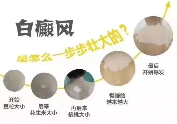 诊断治疗-治疗白癜风应该遵循哪些原则呢-